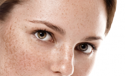 Blepharoplasty Dubai